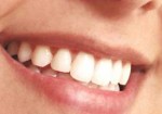implantes-dentarios-ipiranga-1428586394